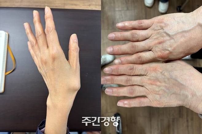 대전 글꽃중학교 조리사의 손. 식판을 닦는 등의 반복 작업으로 왼손 엄지손가락의 연골이 닳아 뼈가 튀어나와 있다.(왼쪽) 대전 둔산여고 조리사의 손. 반복 작업으로 연골이 닳으면 뼈가 뼈끼리 부딪치고 염증이 생기면서 마디가 굵어진다. 이효상 기자