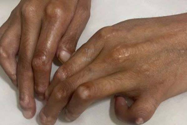 전신성 경화증, 전신성 홍반 루푸스, 셀리악병을 동시에 겪어 석회화와 새끼손가락 변형이 온 여성의 손 모습./사진=미국 의학 사례보고서(American Journal of Case Report)