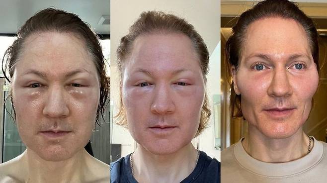 억만장자 브라이언 존슨이 타인의 지방을 주입한 후 얼굴에 부기가 생긴 모습. [인스타그램]