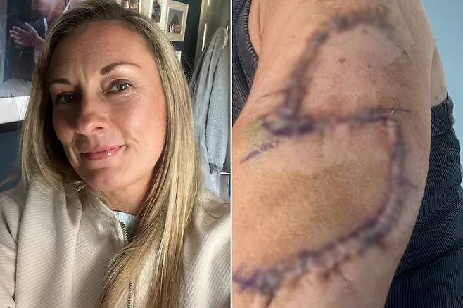 팔에 난 점을 무시했다가 77바늘이나 꿰매는 수술을 받은 40대 영국 여성 사연이 공개됐다. [사진=SNS]