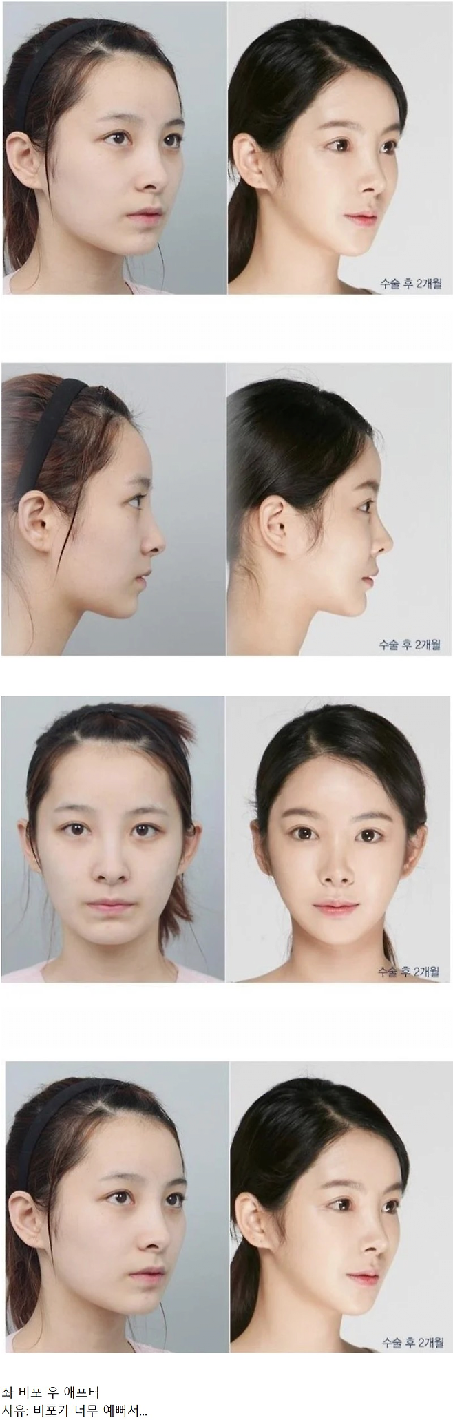 image.png 사람들이 너무 안타까워한 성형외과 비포애프터 사진.jpg 사람들이 너무 안타까워한 성형외과 비포애프터 사진.jpg