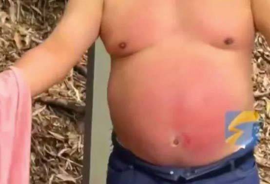 빨개지고 찰과상을 입은 남성의 복부/사진=바스티유포스트