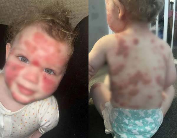 코엔 오셔네시(1)는 태어났을 때부터 습진을 앓았는데, 지난 1월 상태가 급격히 악화하기 시작했다./사진=더 선