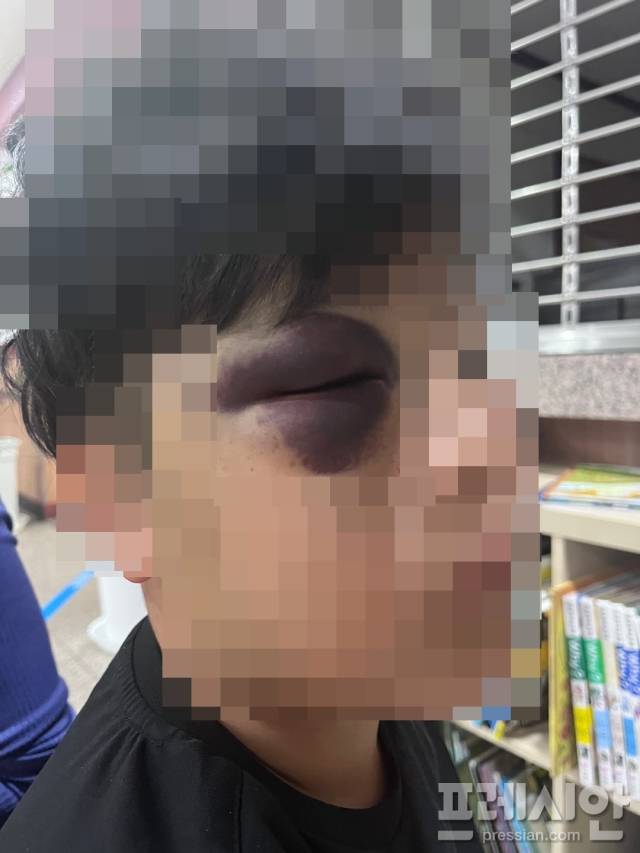 ▲태권도장 사범에게 폭행을 당한 피해 아동, 12살 아동의 얼굴이 피멍으로 가득하다.ⓒ프레시안