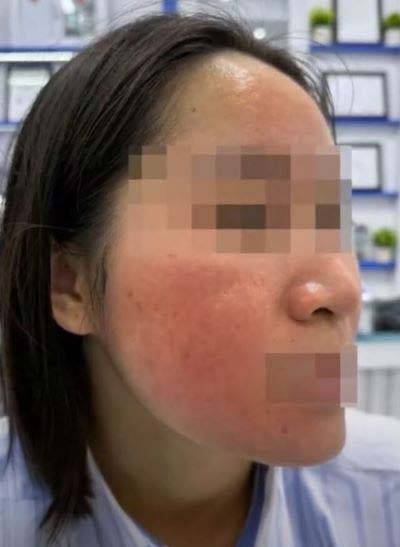 레몬즙을 얼굴에 바른 뒤 ‘자극성 접촉 피부염’ 진단을 받은 A씨의 모습/사진=자딘 닷 베트남