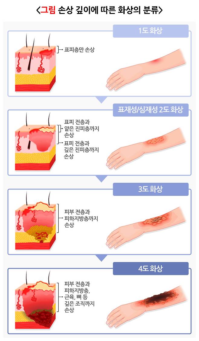 손상 깊이에 따른 화상의 분류. /자료=질병관리청 국가건강정보포털