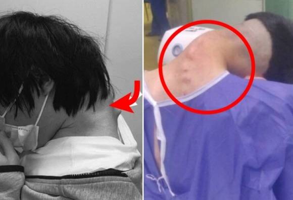 왼쪽은 2023년 JOS케이스리포츠에 공개된 25세 남성, 오른쪽은 최근 이란 이스파한대 의대 신경외과 의료진이 사례를 공개한 환자.  두 사람 모두 머리떨굼증후군 진단을 받았다. JOS케이스리포츠 제공