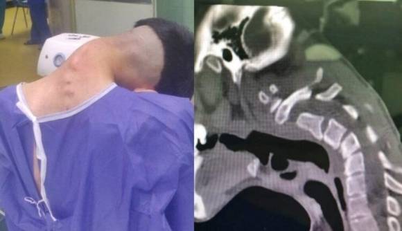 마약 중독으로 인한 잘못된 습관으로 머리떨굼증후군 진단을 받은 23세 남성 환자. 클리니컬 케이스리포츠 제공