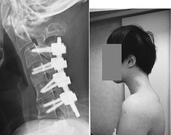 2023년 JOS케이스리포츠에  의료 사례가 공개된 25세 남성. 뼈에 보정물을 넣어 고정시키는 수술을 받고 일상을 회복했다. JOS 케이스리포츠 제공