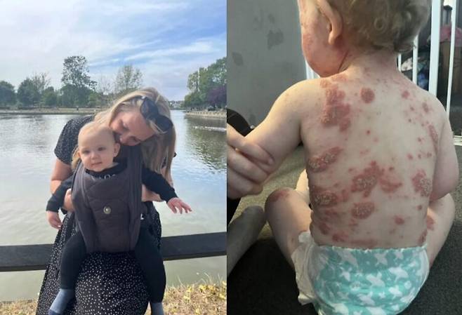 얼굴부터 발끝까지 온몸이 발진과 상처로 뒤덮인 아이의 사연이 소개됐다. [사진=SNS]