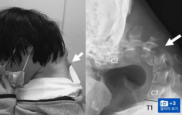 일본 의료진이 공개한 25세 남성의 충격적인 목 부위 스캔 이미지. 목과 척추가 어떻게 변형됐는지를 보여주고 있다. [데일리메일 캡처]