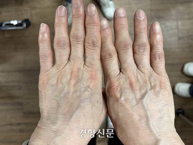 대전 둔산여고 조리사의 손. 반복 작업으로 연골이 닳으면 뼈가 뼈끼리 부딪치고 염증이 생기면서 마디가 굵어진다. 이효상 기자