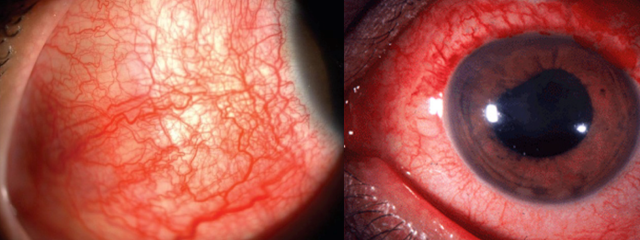 포도막염으로 충혈된 눈. 사진 제공=순천향대서울병원