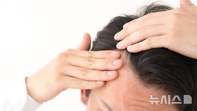 [서울=뉴시스]매년 5월 셋째주 월요일은 올해 만 19세가 되는 젊은이들을 축하하기 위해 제정된 ‘성년의 날’이다. 그러나 20대 때부터 탈모로 고민하는 남성들이 늘고 있다. 어릴수록 탈모로 삶의 질이 크게 저하되고 탈모가 빨리 시작될수록 자존감에 부정적인 영향을 끼치는 것으로 나타나 주의가 요구된다. (사진= 어도비 스톡 제공) 2025.05.18. photo@newsis.com.