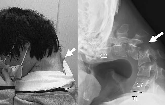 장시간 스마트폰 사용으로 인해 목뼈가 굳은 청년 [사진 출처 = 데일리메일]