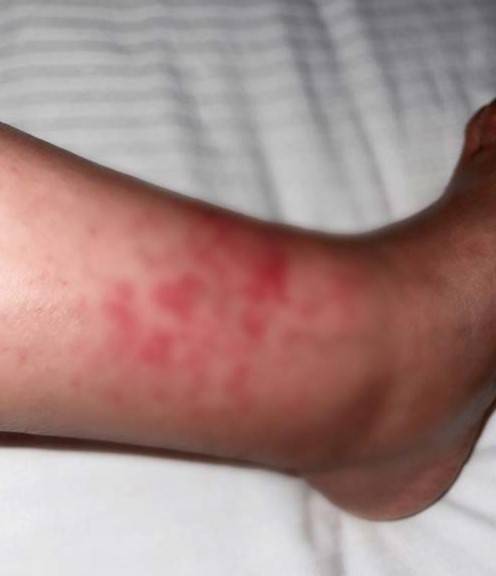 유럽 50대 여성이 4일 동안 매일 야외에서 3만 보 이상을 걸은 뒤 유발된 운동 유발 혈관염의 모습/사진=큐레우스