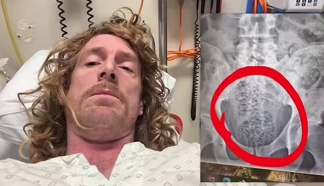 [뉴시스] 호주의 유명 유튜버가 통원두를 삼켰다가 장폐색으로 병원에 실려가 수술을 받았다. 마이클 브룩하우스의 당시 모습. (사진 = 인스타그램 캡처) 2025.05.19. *재판매 및 DB 금지