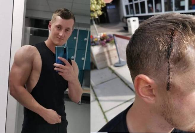 체력관리에 힘쓰던 운동 마니아였던 30대 남성이 두통이 생기고 코피가 잦아지는 증상을 겪다, 아스트로사이토마이라는 뇌종양을 진단받은 사연이 전해졌다.[사진=SNS]