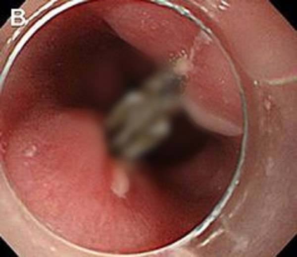 생선은 각종 건강 효능이 있는 밥반찬 중 하나다. 하지만, 생선뼈를 잘못 삼킬 경우 출혈이나 천공 등 치명적인 합병증을 유발할 수 있어 주의해야 한다./사진=대한위장벽학회지