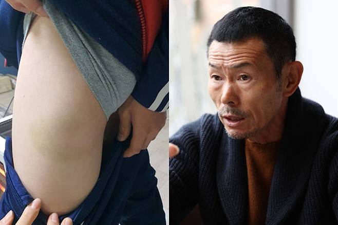 손웅정 SON축구아카데미 감독(오른쪽)을 아동학대 혐의로 고소한 학생 측이 사건 발생일 이후 사흘이 지난 지난해 3월12일 촬영한 멍자국. 연합뉴스