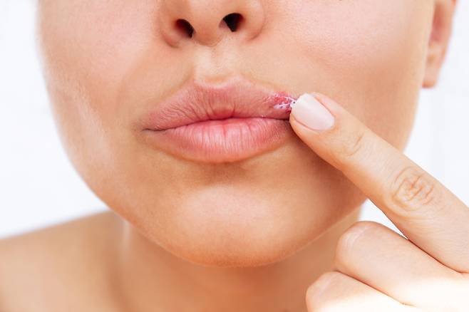 입 주변에 포진과 홍반을 일으키는 헤르페스 1형 바이러스인 구순 단순포진바이러스(HSV-1)가 알츠하이머병 발병에 중요한 역할을 할 수 있다는 새로운 대규모 연구결과가 나왔다. [사진=게티이미지뱅크]