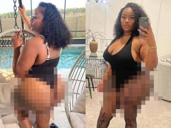 미국의 한 인플루언서가 엉덩이 성형 수술을 받은 수혈까지 받은 사연을 공개했다./사진=더 선