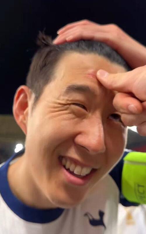 이마에 난 상처를 보여주는 손흥민