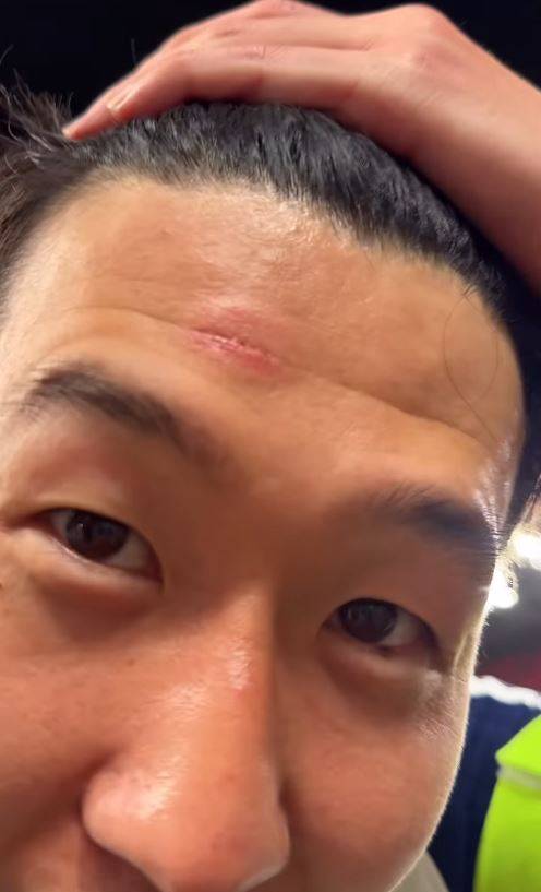 22일 토트넘 공식 사회관계망서비스(SNS)를 통해 공개된 영상에는 손흥민이 상처 부위를 손으로 가리키며 해맑게 웃고는 '트로피를 들어 올리는 순간 누가 뒤에서 밀었다. 그래서 트로피에 이마를 부딪혀 이렇게 상처가 났다'고 말하는 장면이 담겨 있었다. 팬들은 해당 영상 댓글란을 통해 열렬히 반응했다. '해리포터보다 멋진 상처', '진짜 챔피언의 상징', '15년의 집념이 새겨진 흔적'이라는 댓글이 붙었다. 토트넘 홋스퍼