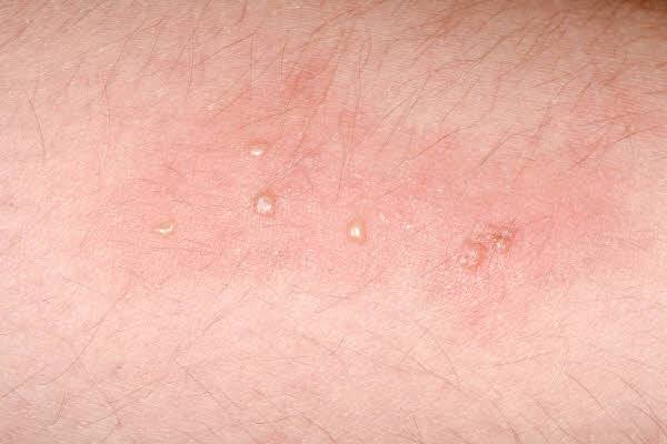 대상포진은 피부 병변, 통증 등을 동반하는 질환으로 성인 세 명 중 한 명이 겪는다고 보고된다./사진=클립아트코리아