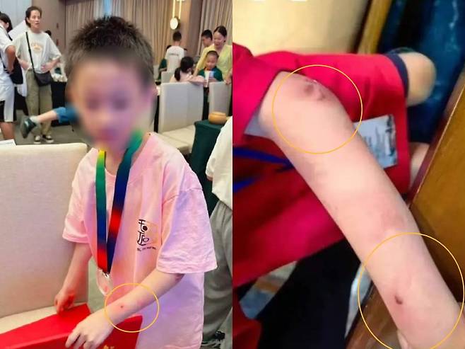 온라인을 통해 확산되고 있는 주훙신의 폭행 흔적/사진=SNS 캡처