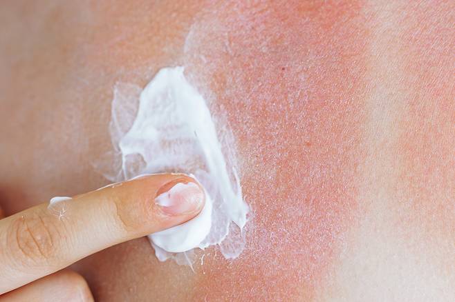 일광화상 빠른 회복을 위해 햇볕에 탄데 바르는 '햇빛화상' 전용 외용제를 활용하는 것이 좋다. [사진=게티이미지뱅크]