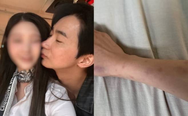 A씨가 지난 24일 인스타그램에 올린 전호준과 함께 찍은 사진과 멍이 든 신체 사진. A씨 인스타그램 갈무리