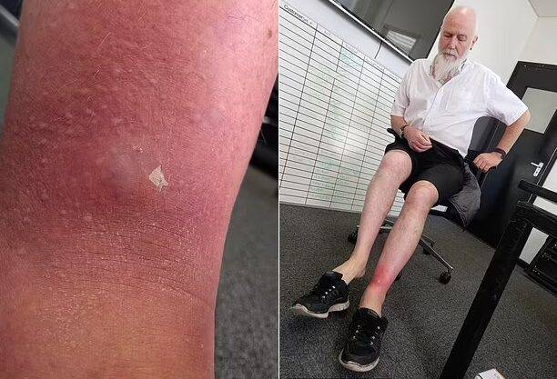 거미에게 물린 뒤 봉와직염 진단을 받은 60대 영국 남성 사연이 공개됐다. [사진=SNS]