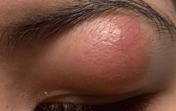눈꺼풀에 모질기종이 생긴 10대 소녀의 모습./사진=큐레우스