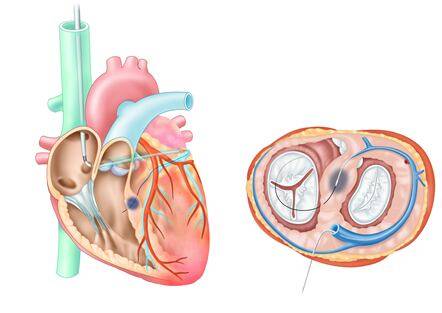 타우메디칼의 스루셉탈 시술도구(TIRA)의 비후성 심근증 치료 그림./타우메디칼