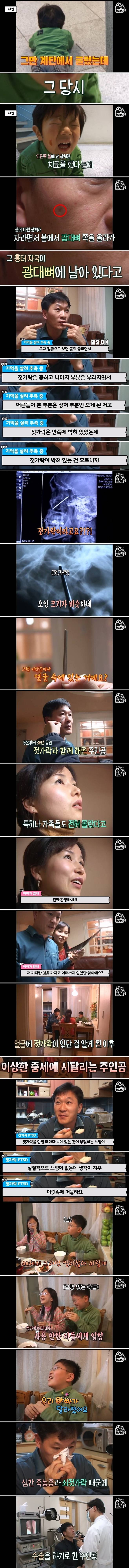 Internet_20240524_032454_3.jpeg 축농증 수술하러 갔다가 얼굴에서 발견한 물건의 정체 축농증 수술하러 갔다가 얼굴에서 젓가락이 나온 사람 ㄷㄷ