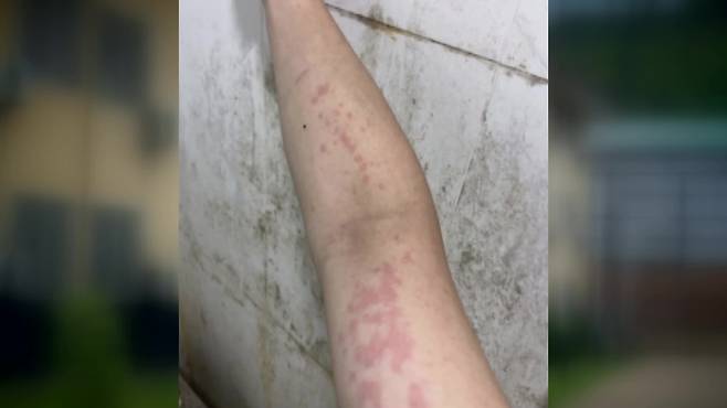 실적이 없으면 매일 폭행이 이어졌다. 박 씨의 다리에 멍이 들어 있고, 비위생적인 환경 때문에 피부에 붉은 반점이 올라와 있다.(박 씨 촬영)