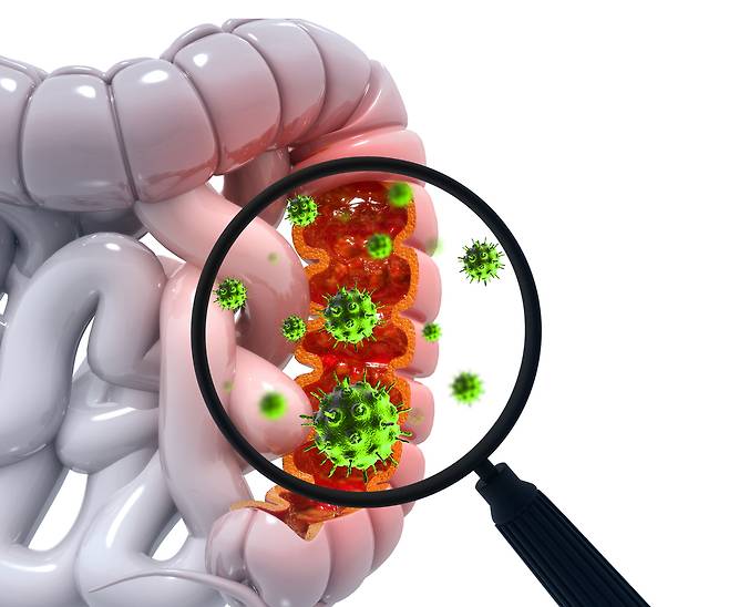 40대 이하 젊은 대장암 환자가 매해 꾸준히 늘며 지난해 2만2706명이 발생했다. 게티이미지뱅크