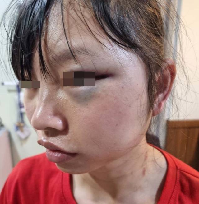 ▲5월 19일 양계장에서 일하던 중 40대 남성인 부장에게 50여분간 무차별 폭행을 당한 황하씨. 안면부, 목, 귓등에 폭행 당한 흔적이 남아있다. ⓒ고기복