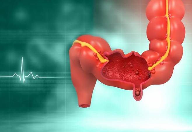 대장에 생긴 종양 중 선종을 비롯한 일부 종양은 반드시 제거해야 한다. 게티이미지뱅크 제공.