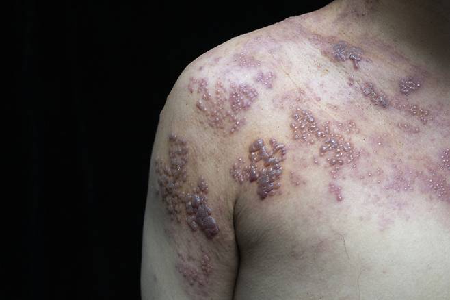 몸의 한쪽으로만 나타나는 대상포진 병변.