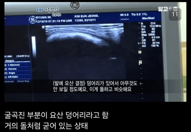 통풍 방치하면 안되는이유