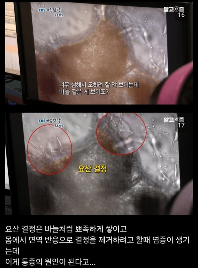 통풍 방치하면 안되는이유