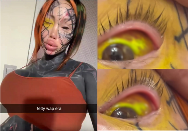 눈알(공막, 흰자)에 형광색 문신을 시도했다가 큰 부작용을 겪고 있는 메리 매들린. 과잉 주입된 노란색 잉크가 눈의 가장자리에 고여 '덩어리'처럼 뭉쳤고, 눈 주변 피부까지 착색되는 등 예상치 못한 부작용이 발생했다. [사진=SNS]