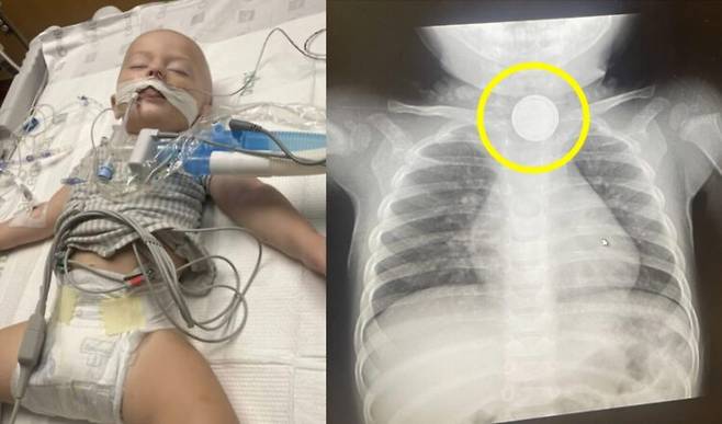 장난감 리모컨 등에 흔히 사용되는 동전 배터리를 삼킨 아이가 검은색 이물질들을 토해내다 죽을 뻔한 사연이 공유됐다. [사진=SNS]