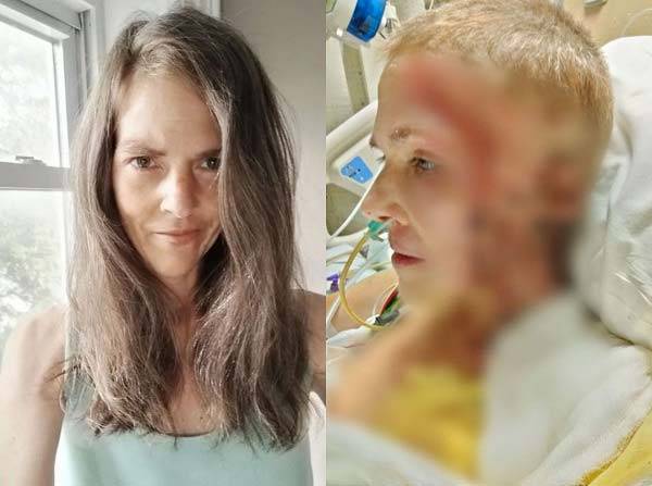 미국의 40대 여성이 전자담배 불꽃으로 전신에 3도 화상을 입고, 3년째 재활 치료를 이어가고 있는 사연이 전해졌다./사진=더선