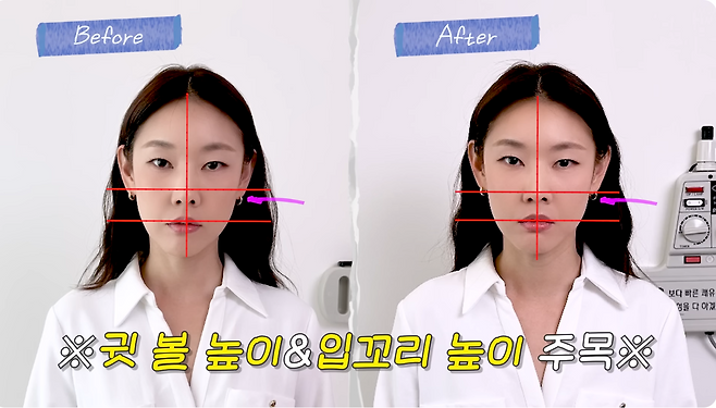 한혜진이 생애&nbsp;처음 받아본 침 성형으로 20분 만에 놀라운 차이를 느꼈다.&nbsp;유튜브 채널 ‘한혜진 Han Hye Jin’ 캡처