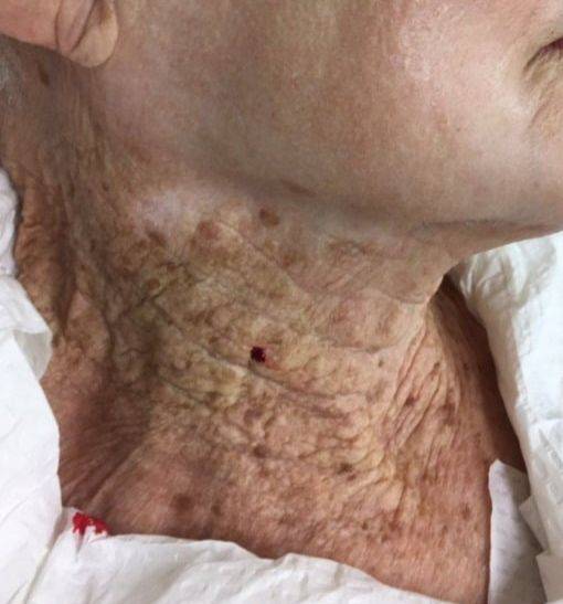 40년 동안 얼굴에만 선크림을 바른 92세 여성의 뺨과 목 피부 상태. 유럽 피부과 학회지 캡처