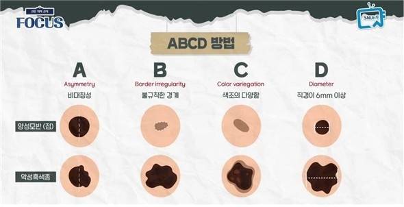 ABCD 자가진단 체크포인트 [서울대병원 제공]