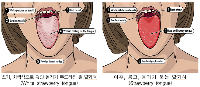 성홍열은 얼굴이 붉게 달아오르고 입 주위는 창백해지며, 혀는 딸기처럼 붉고 오돌토돌한 모양으로 변하는 것이 특징이다. 사진=제주도 제공